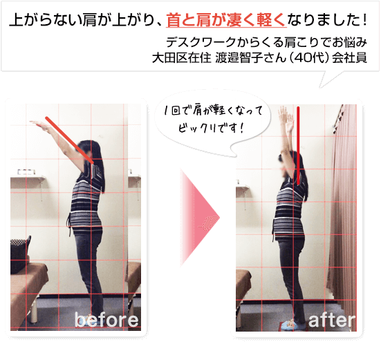 大田区大森在住の渡邉さんの声。施術の後は肩が上がるようになり、首と肩がとても軽くなりました!